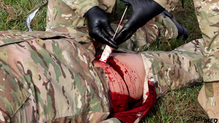 Военные впервые использовали устройство для остановки кровотечений XStat-30