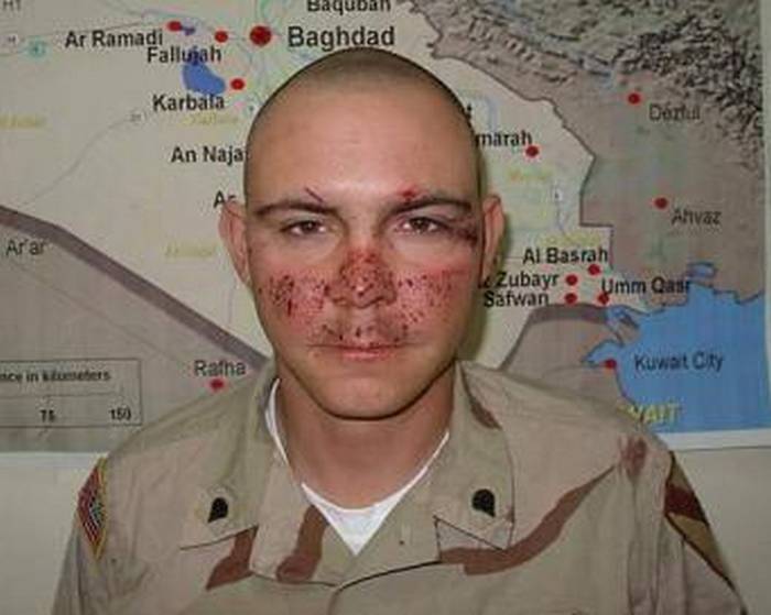 Лицо солдата после осколочного ранения. Четко виден след от очков.