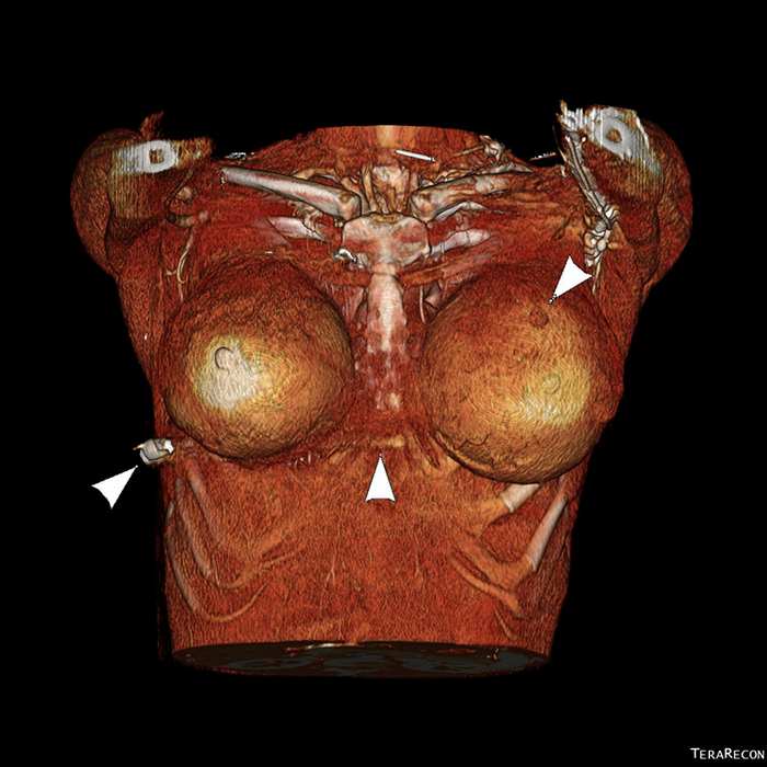 3-мірне (3D) переформатоване об'ємне зображення демонструє вхідну рану лівої грудної клітки (стрілка праворуч), тракт кулі з порушенням м'яких тканин (середня стрілка) та кулю в правій бічній грудній стінці (стрілка ліворуч).