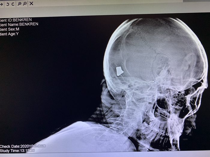 Рентген голови