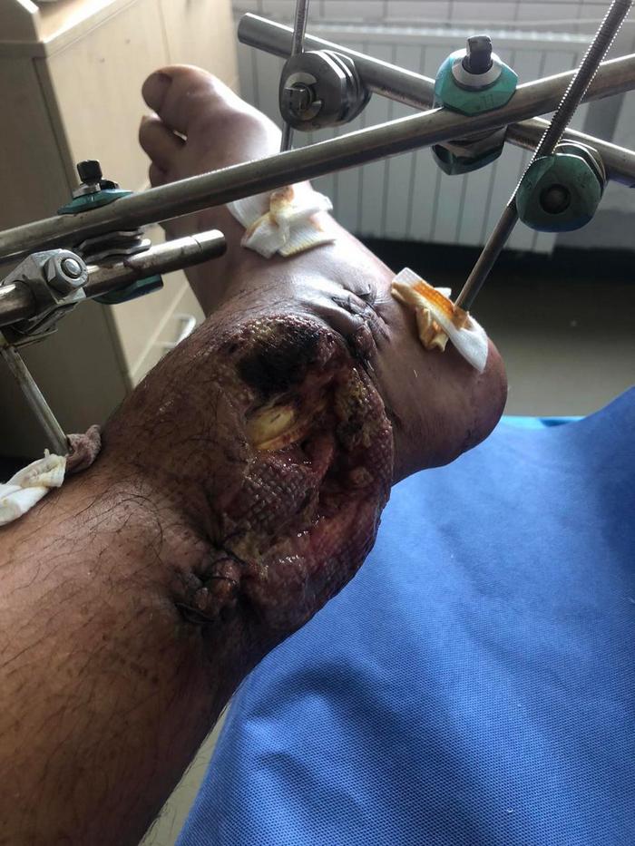 Розтрощені ноги Максима Шпетка 