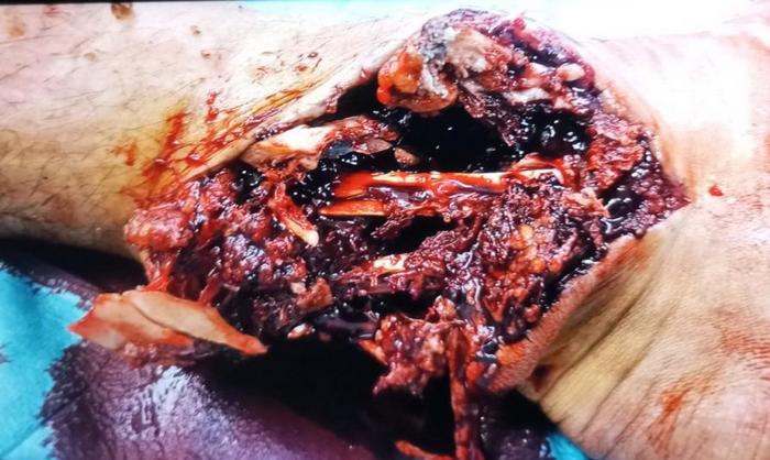 Розтрощені ноги Максима Шпетка 